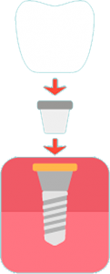 Illustration of a dental implant showing how the abutment fits on the fixture and the crown fits on the abutment